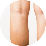 Tratamiento de varices sin cirugía