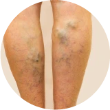 Tratamiento de varices sin cirugía