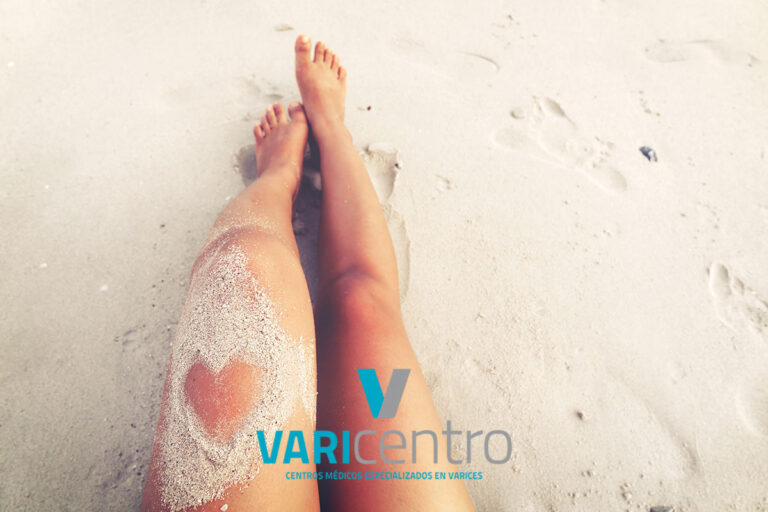 Consejos para cuidar tus varices en la playa