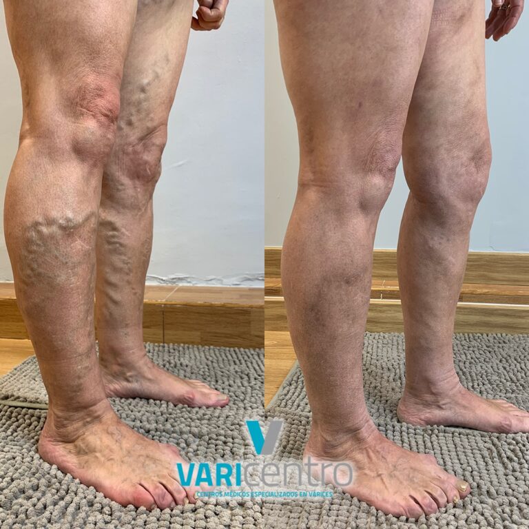 Tratamiento de varices tronculares