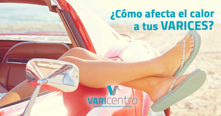 ¿Cómo afecta el calor a tus varices?