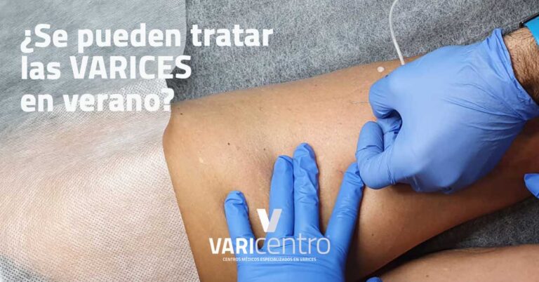 ¿Se pueden tratar las varices en verano?