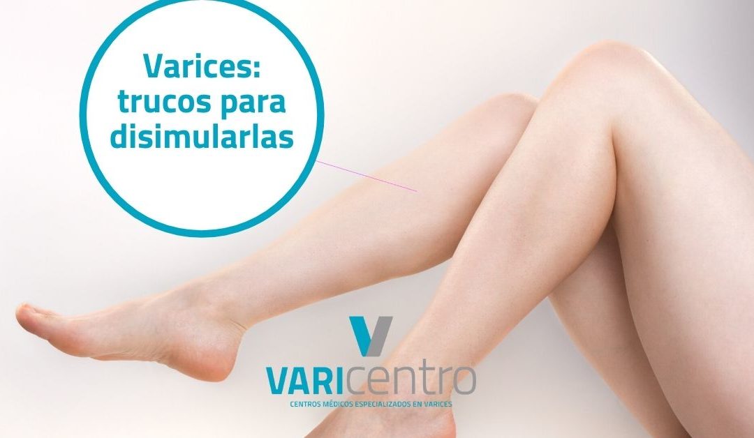 Varices: trucos para disimularlas