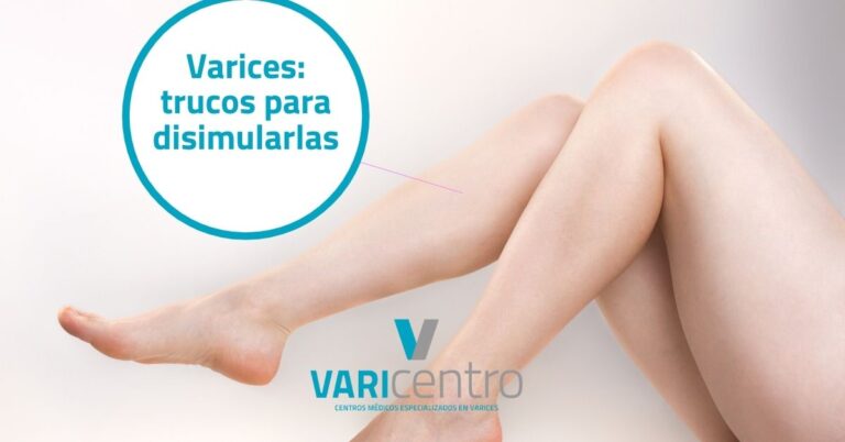 Varices: trucos para disimularlas Varices: trucos para disimularlas