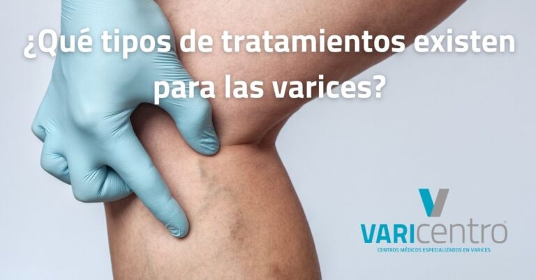 ¿Qué tipos de tratamientos existen para las varices?