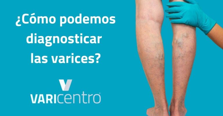 ¿Cómo podemos diagnosticar las varices?