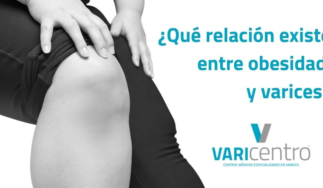 Relación entre obesidad y varices