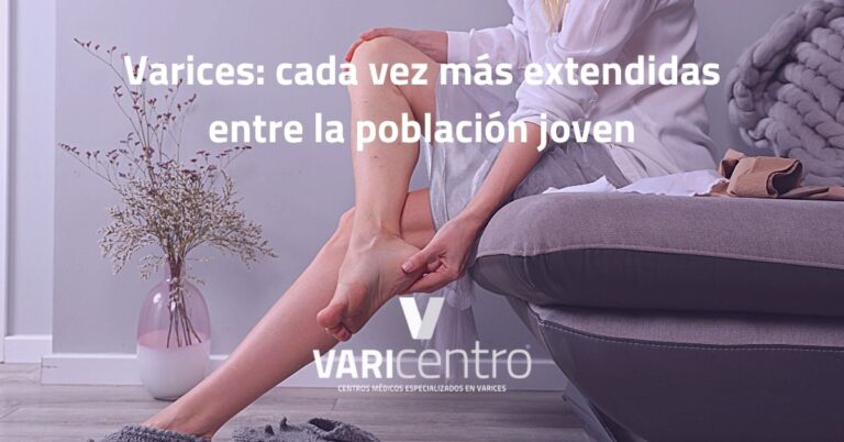 Varices: cada vez más extendidas entre la población joven