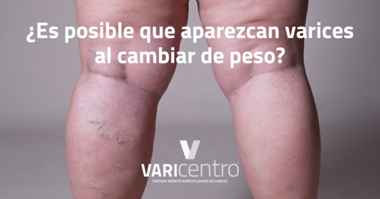 varices y peso