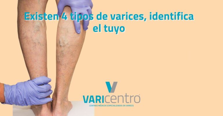 4 tipos de varices que existen: identifica el tuyo
