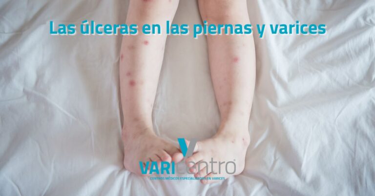 Las úlceras en las piernas y varices