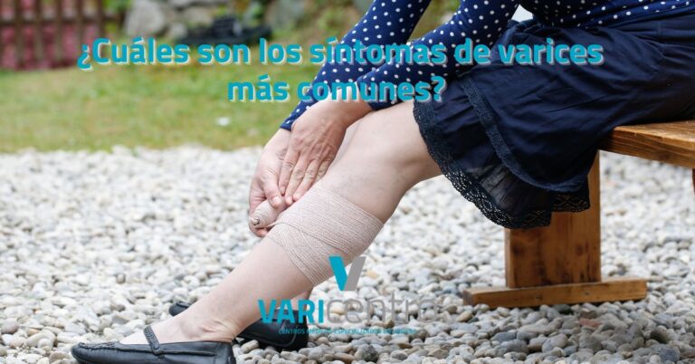 ¿Cuáles son los síntomas de varices más comunes?