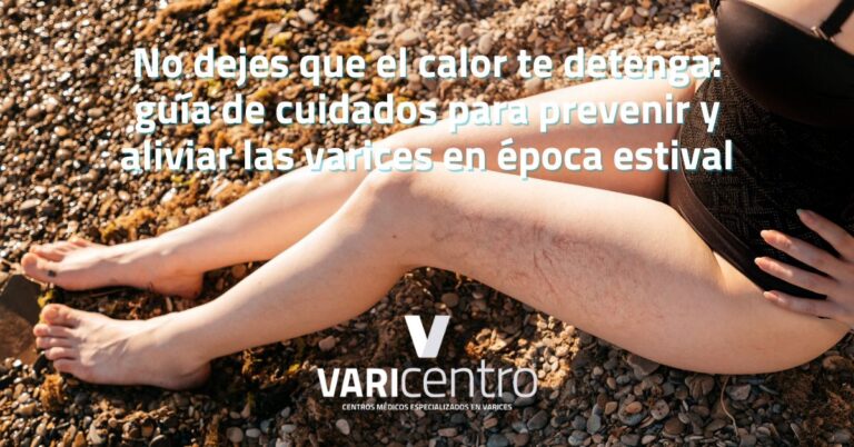 No dejes que el calor te detenga: guía de cuidados para prevenir y aliviar las varices en época estival No dejes que el calor te detenga: guía de cuidados para prevenir y aliviar las varices en época estival