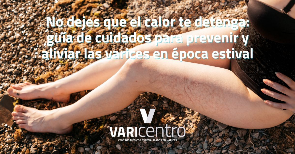 No dejes que el calor te detenga: guía de cuidados para prevenir y aliviar las varices en época estival