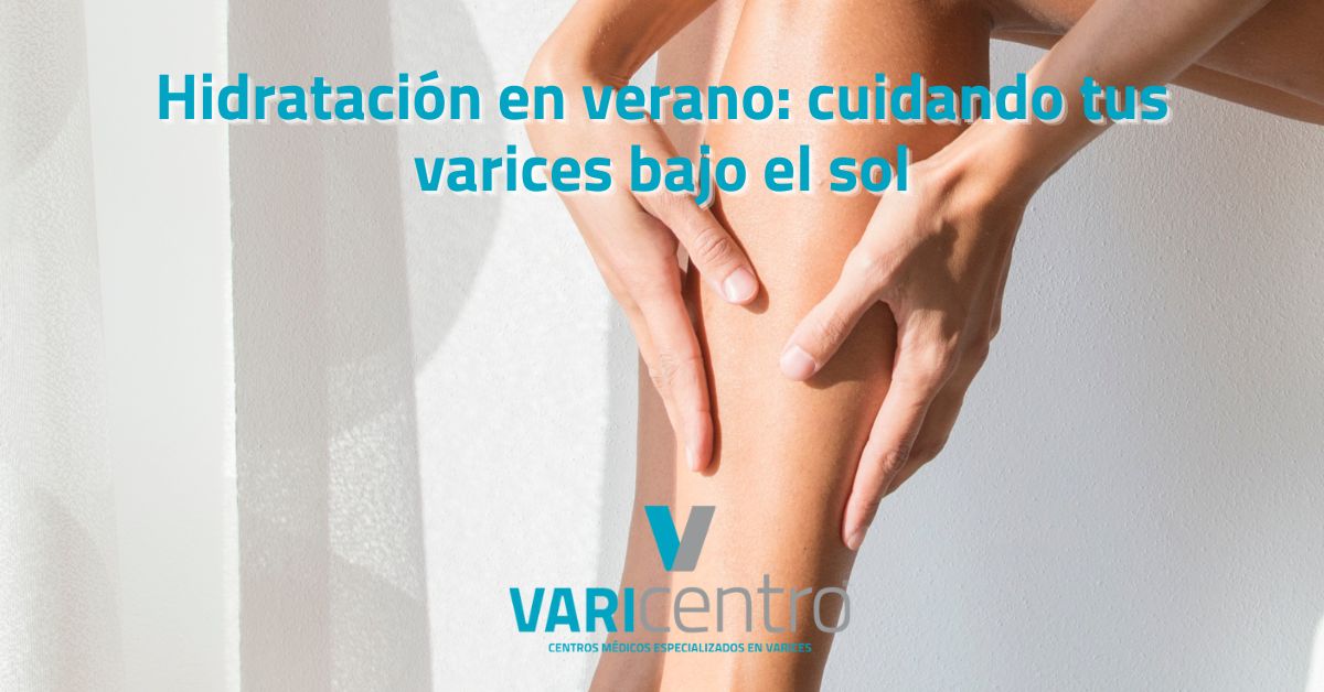 Hidratación en verano: cuidando tus varices bajo el sol