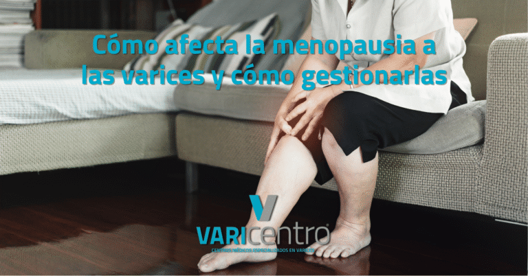 Cómo afecta la menopausia a las varices y cómo gestionarlas Cómo afecta la menopausia a las varices y cómo gestionarlas