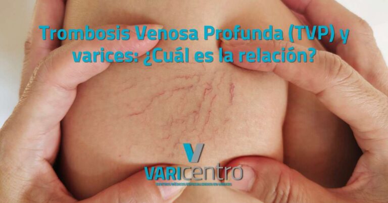 Trombosis venosa profunda (TVP) y varices: ¿Cuál es la relación? trombosis venosa profunda (TVP) y varices ¿Cuál es la relación?