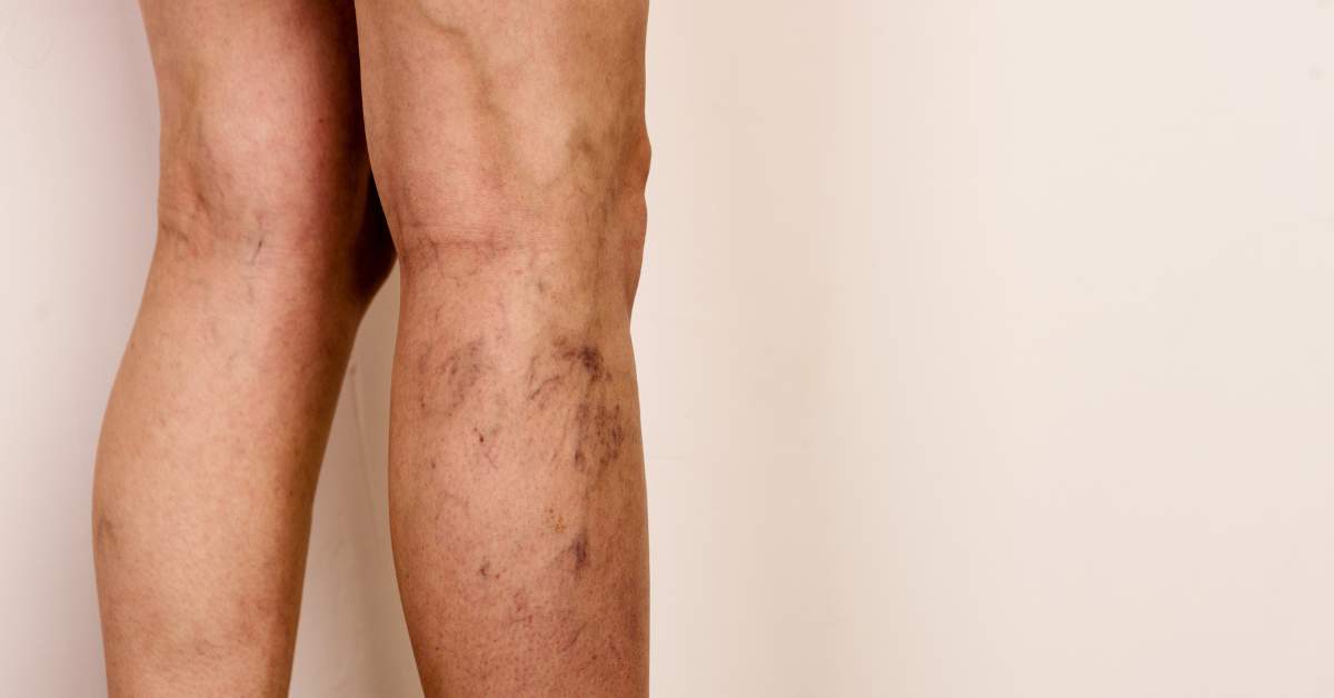 Controla tus varices con estos consejos