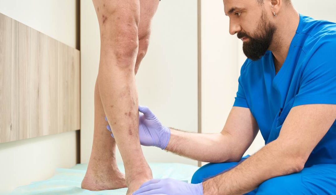 Varices en los hombres: cómo afrontarlas y tratarlas sin tabúes