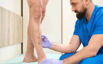 Varices en los hombres: cómo afrontarlas y tratarlas sin tabúes