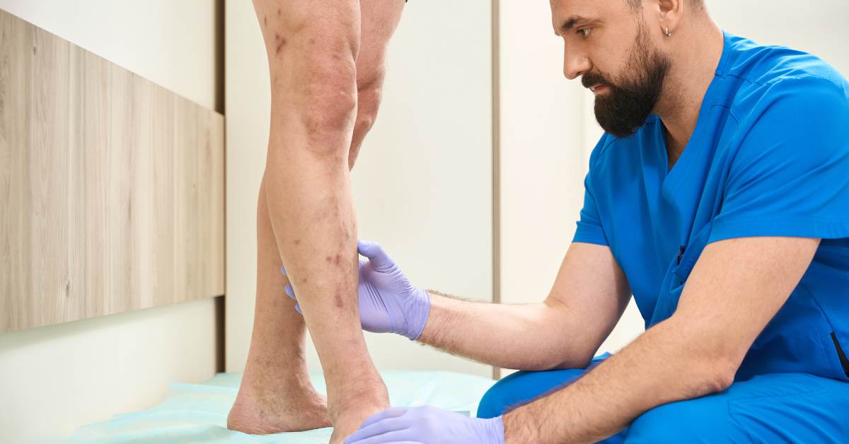 Varices en los hombres: cómo afrontarlas y tratarlas sin tabúes Varices en los hombres