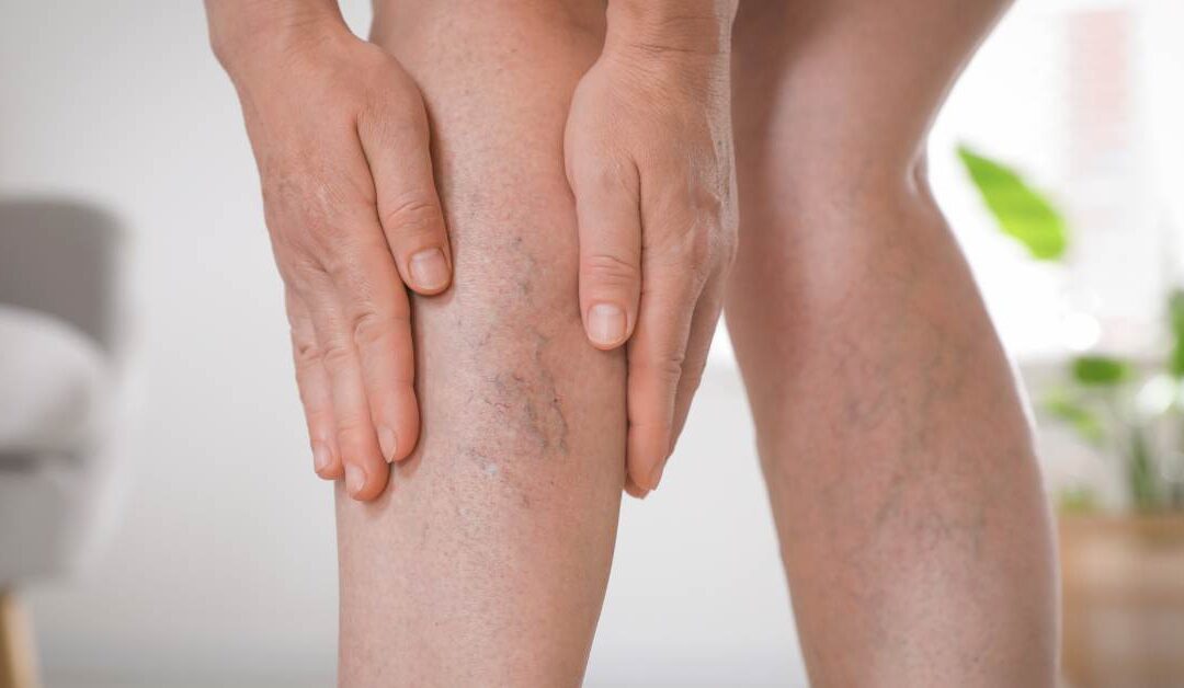5 signos tempranos de las varices y cómo actuar a tiempo