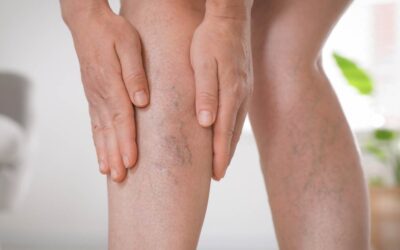 5 signos tempranos de las varices y cómo actuar a tiempo