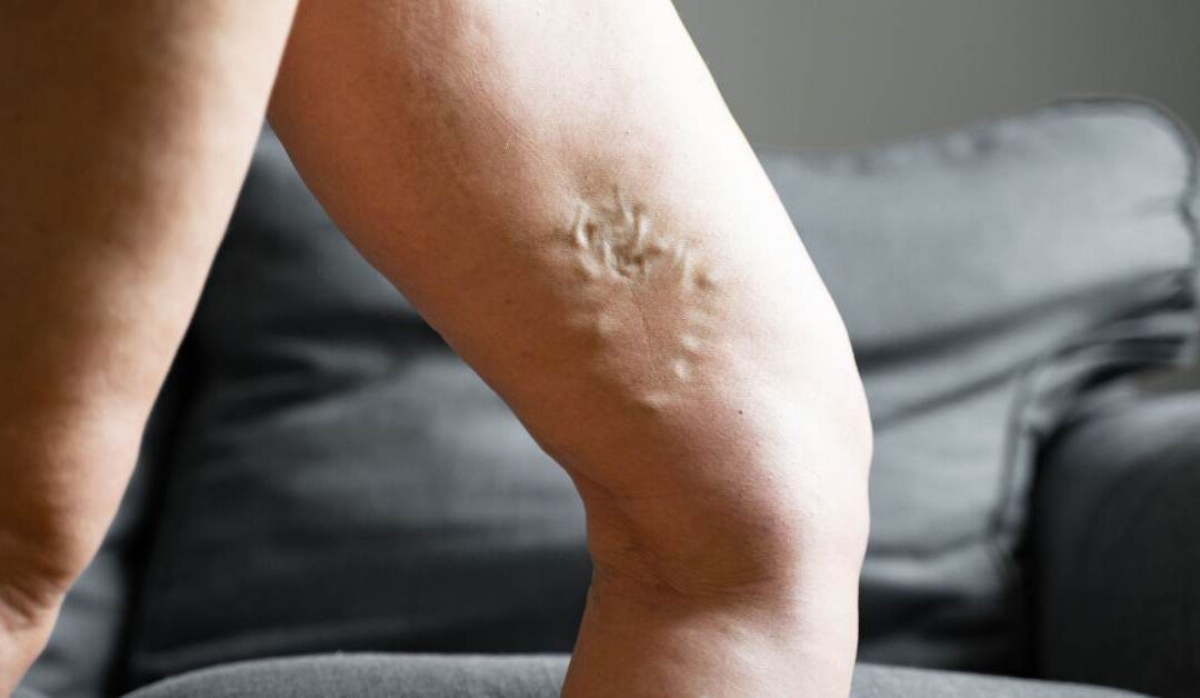 ¿Las varices pueden causar complicaciones graves? Señales de advertencia