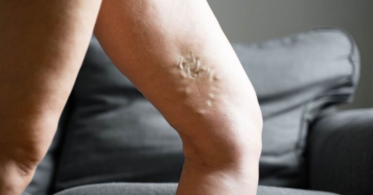 ¿Las varices pueden causar complicaciones graves? Señales de advertencia Señales de varices