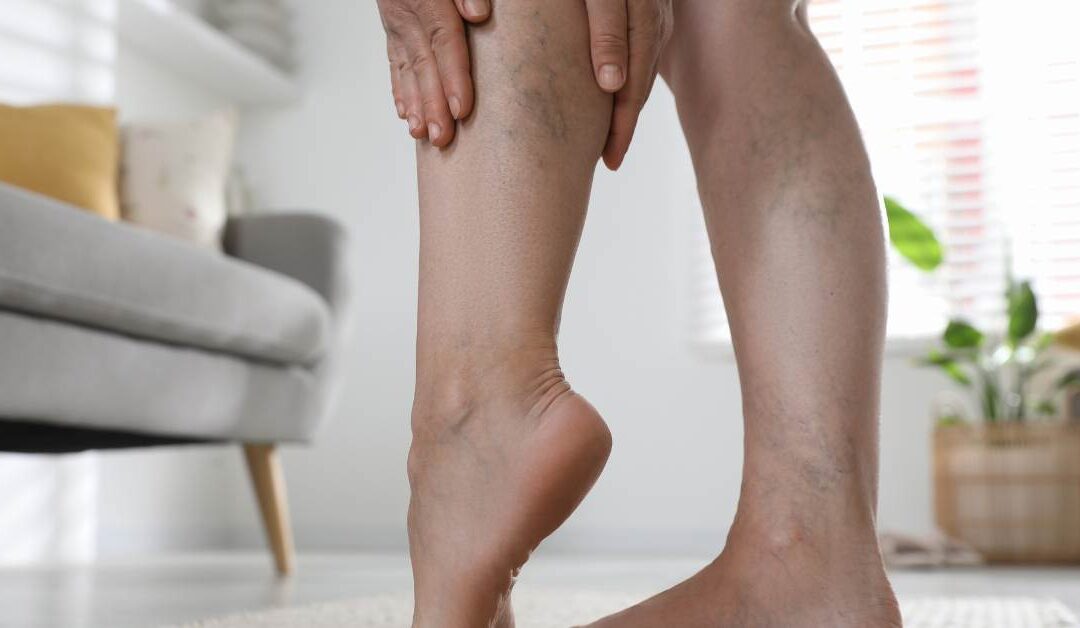 ¿Las varices son hereditarias? La verdad que nadie te ha contado y cómo prevenirlas