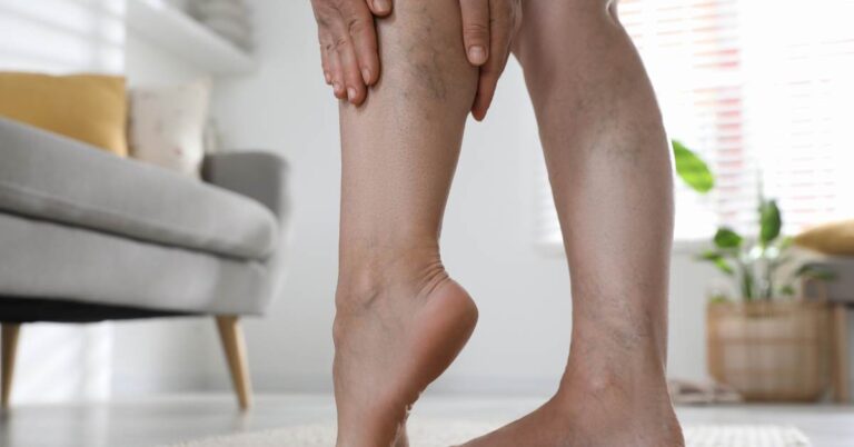 ¿Las varices son hereditarias? La verdad que nadie te ha contado y cómo prevenirlas ¿Las varices son hereditarias?