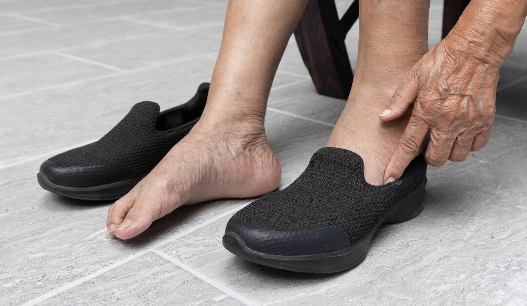 6 consejos para elegir el calzado adecuado y prevenir las varices