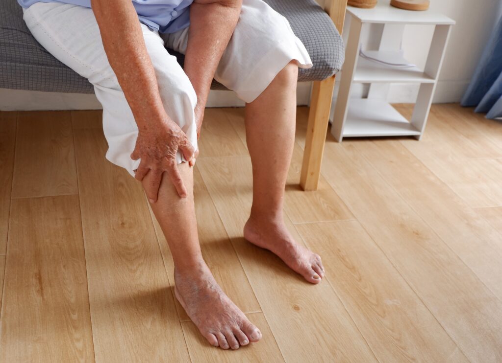 Varices y celulitis, ¿van de la mano o no tienen nada que ver?