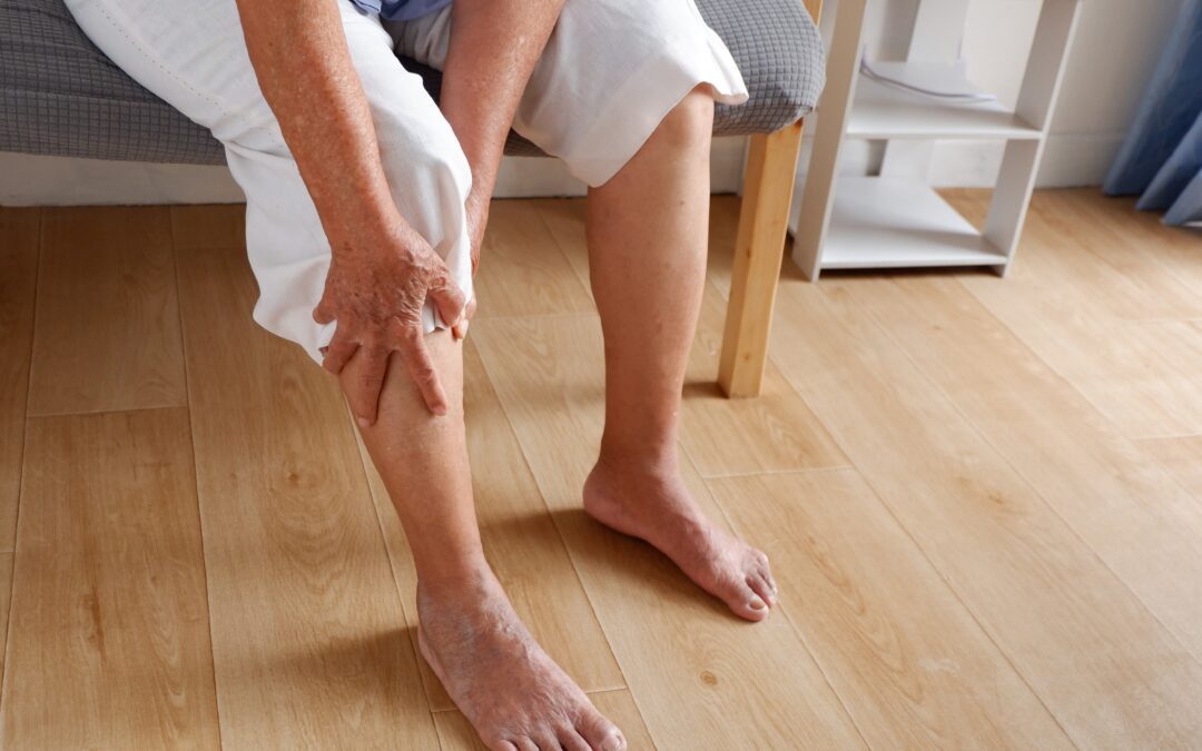 Varices y celulitis ¿van de la mano o no tienen nada que ver?