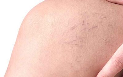 ¿Por qué aparecen las arañas vasculares y cómo prevenirlas?