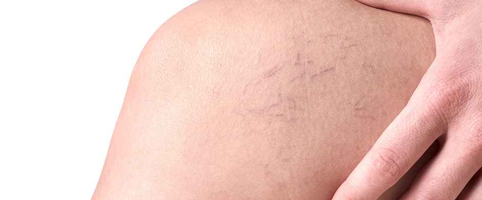 ¿Por qué aparecen las arañas vasculares y cómo prevenirlas?