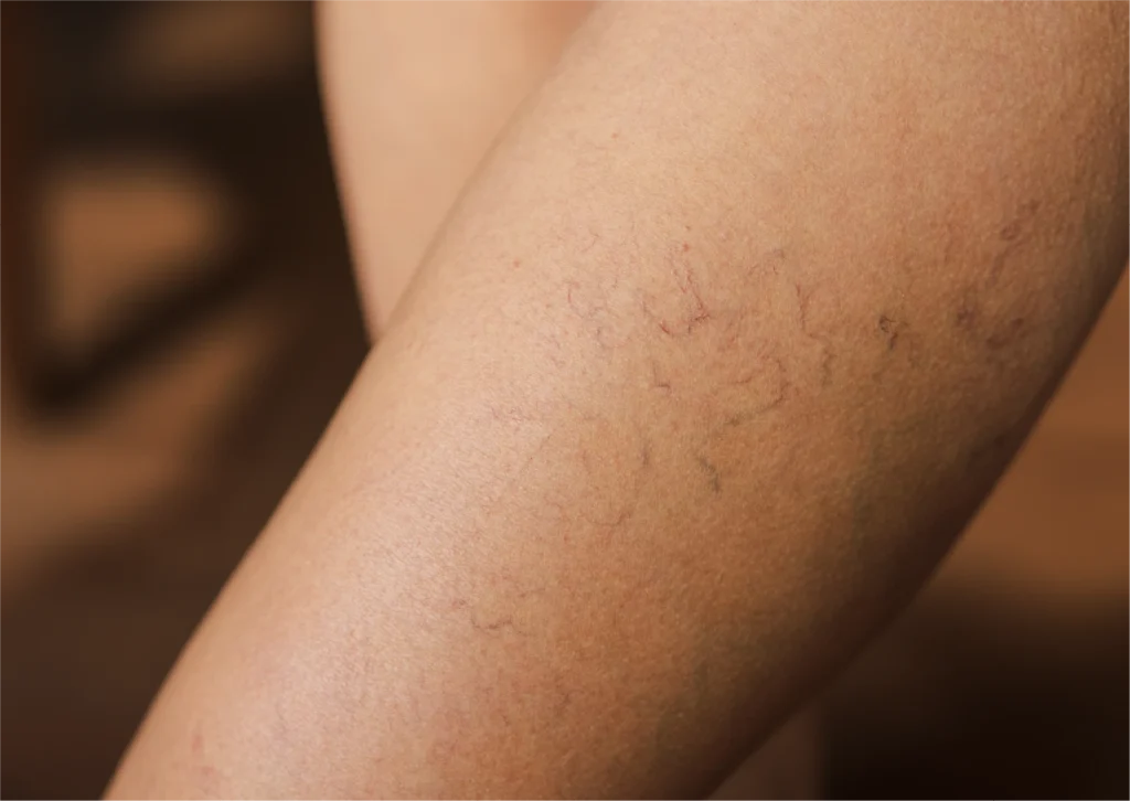 Cómo prevenir las varices