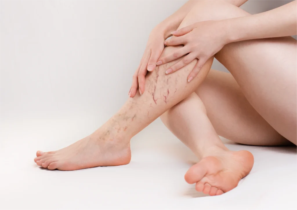 Varices en la mujer y embarazo