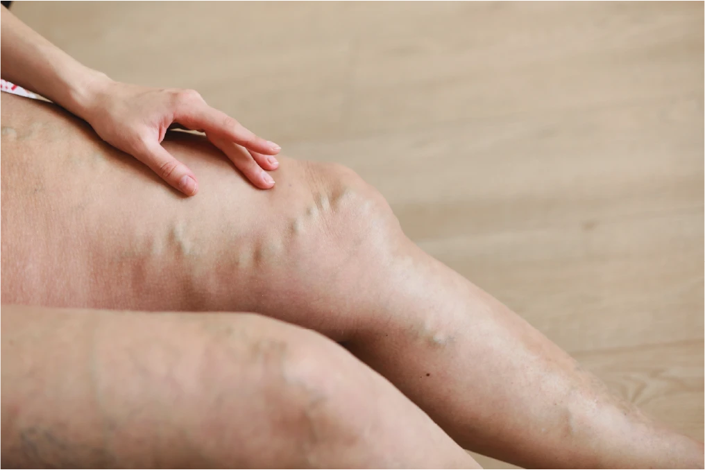 ¿Qué son las varices?