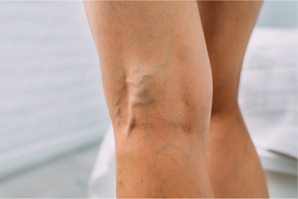 ¿Qué son las varices?