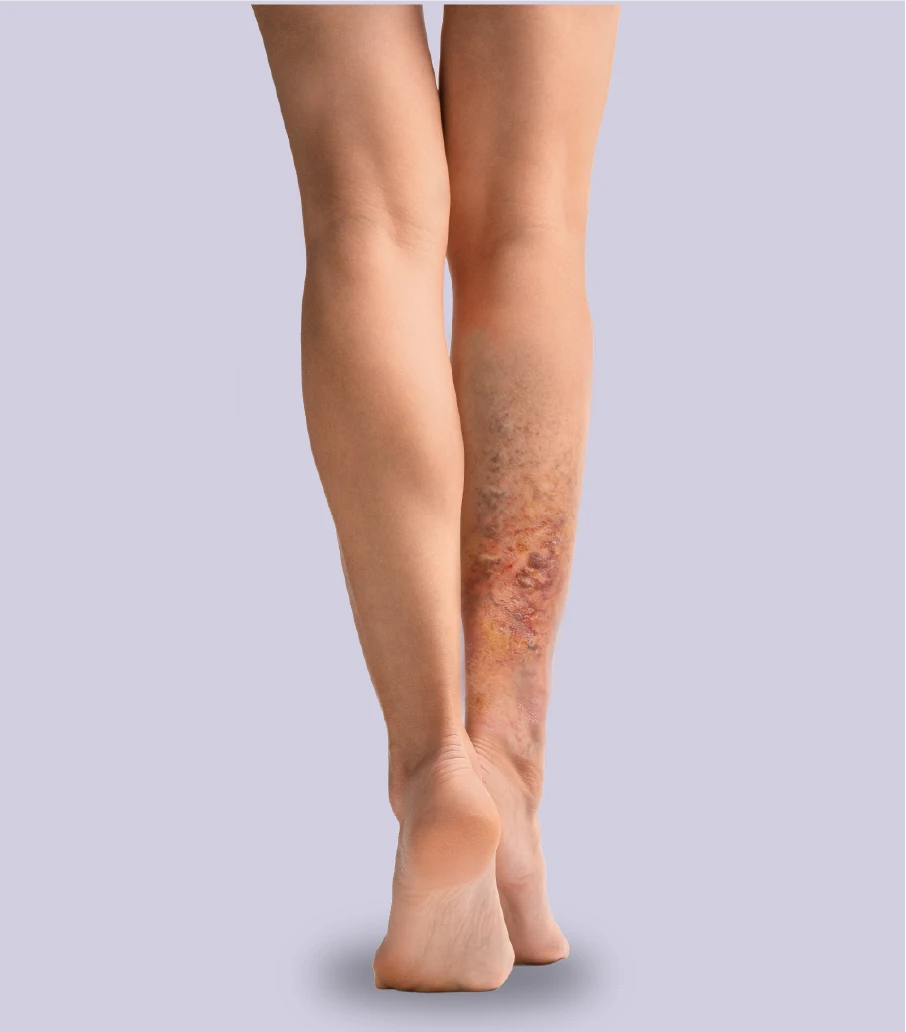 Tipos de varices