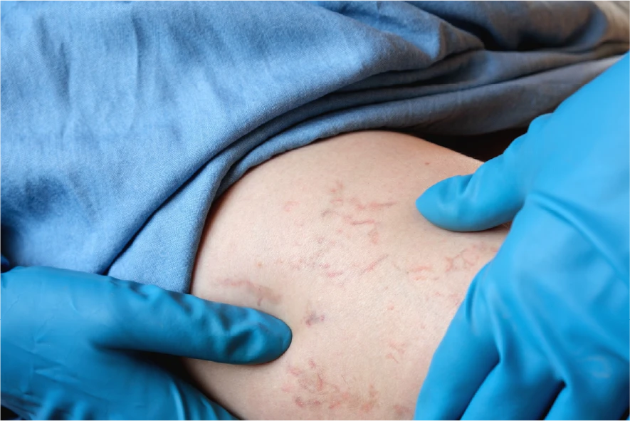 Causas de las varices