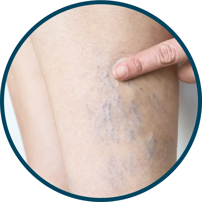 Síntomas de las varices