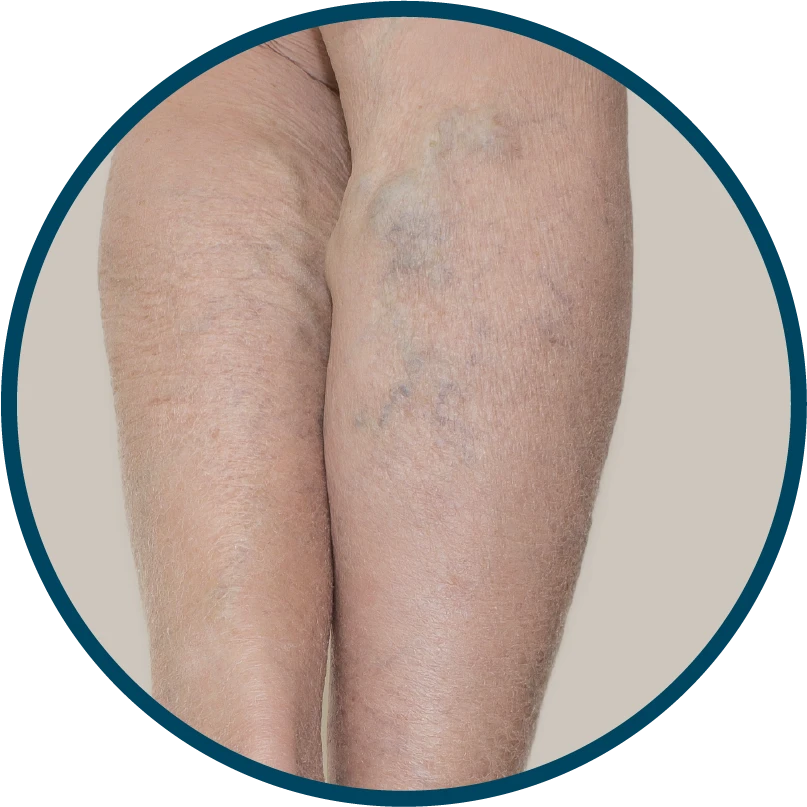 Síntomas de las varices