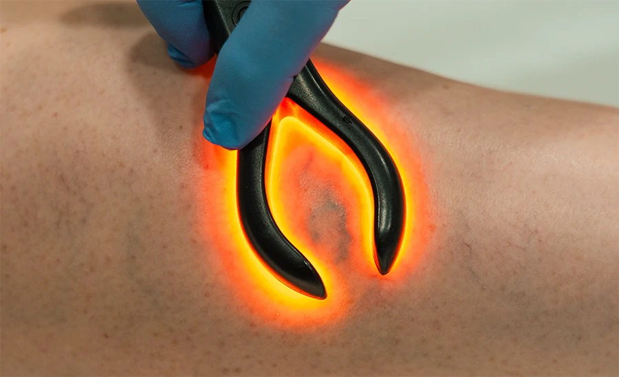 Varices peligrosas