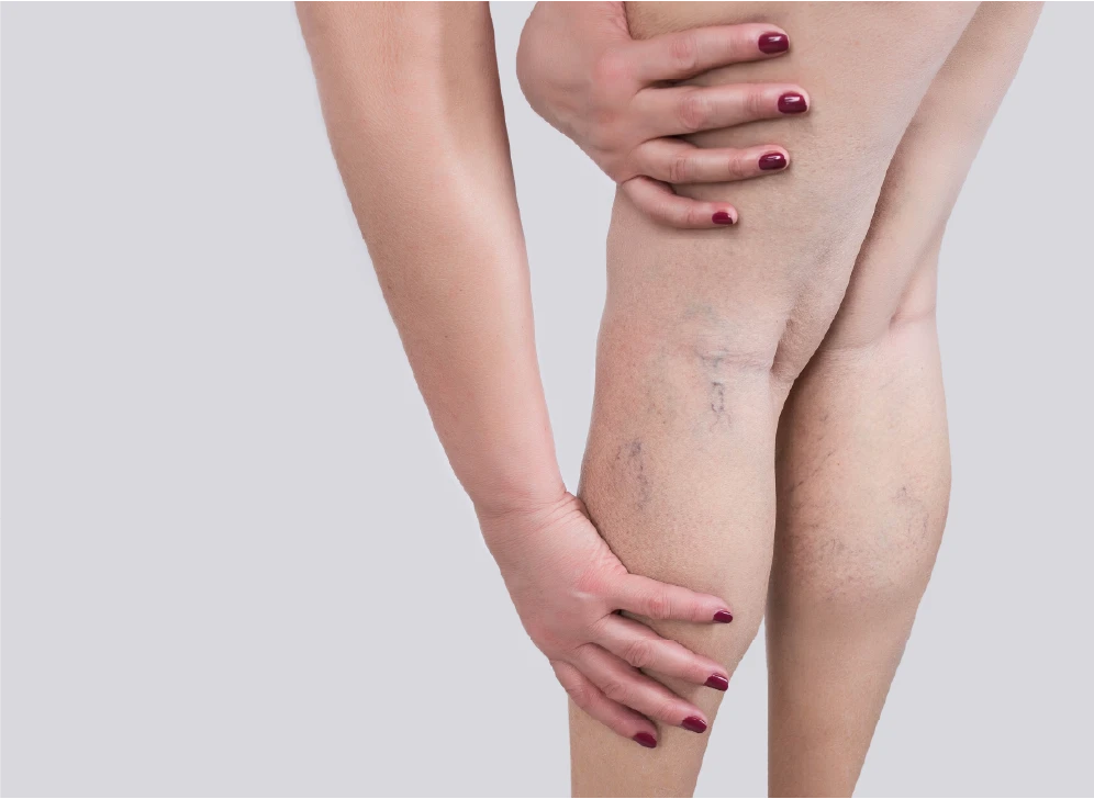 ¿Qué son las varices?