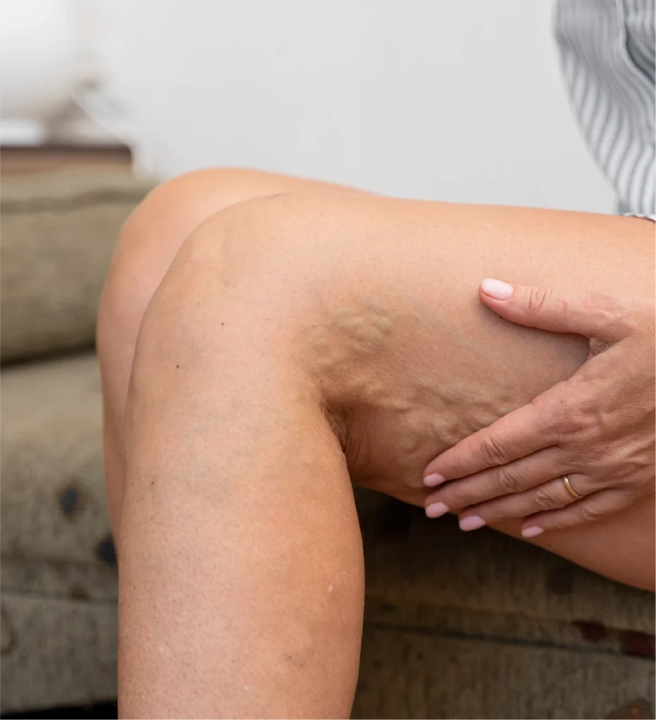 Varices y trabajo de pie (y sentado)