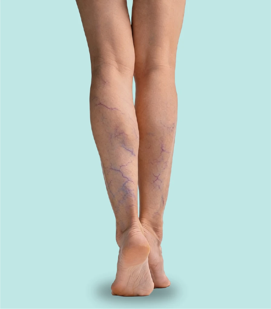 Tipos de varices