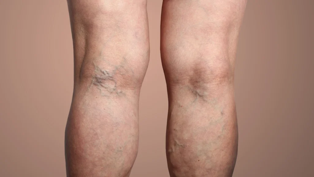 Factores de riesgo de las varices