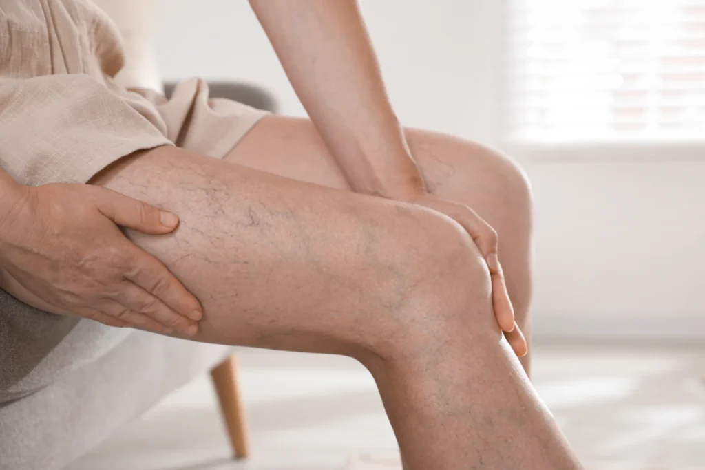 Causas de las varices